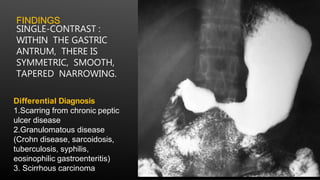 FINDINGS
SINGLE-CONTRAST :
WITHIN THE GASTRIC
ANTRUM, THERE IS
SYMMETRIC, SMOOTH,
TAPERED NARROWING.
Differential Diagnosis
1.Scarring from chronic peptic
ulcer disease
2.Granulomatous disease
(Crohn disease, sarcoidosis,
tuberculosis, syphilis,
eosinophilic gastroenteritis)
3. Scirrhous carcinoma
 
