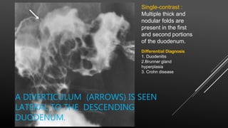 Single-contrast :
Multiple thick and
nodular folds are
present in the first
and second portions
of the duodenum.
A DIVERTICULUM (ARROWS) IS SEEN
LATERAL TO THE DESCENDING
DUODENUM.
Differential Diagnosis
1. Duodenitis
2.Brunner gland
hyperplasia
3. Crohn disease
 
