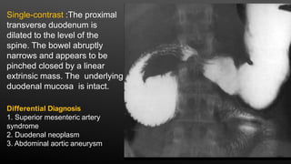 Single-contrast :The proximal
transverse duodenum is
dilated to the level of the
spine. The bowel abruptly
narrows and appears to be
pinched closed by a linear
extrinsic mass. The underlying
duodenal mucosa is intact.
Differential Diagnosis
1. Superior mesenteric artery
syndrome
2. Duodenal neoplasm
3. Abdominal aortic aneurysm
 