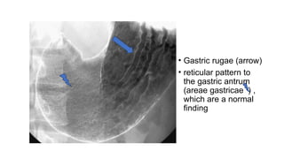 Barium meal. How to perform and interpret | PPTX