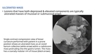 Lesser Compression Barium meal. How to perform and interpret | PPTX