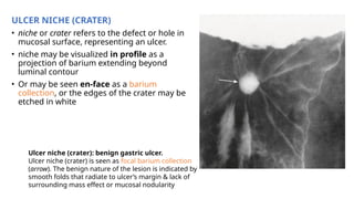 Barium meal. How to perform and interpret | PPTX