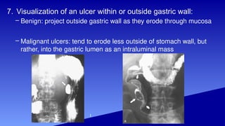 bariummeal and pathologies by Dr Sana Faizan | PPTX