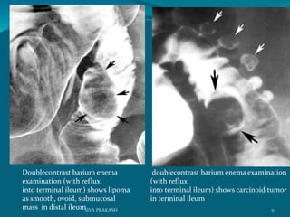 doublecontrast barium enema examination
(with reflux
into terminal ileum) shows carcinoid tumor
in terminal ileum
Doublecontrast barium enema
examination (with reflux
into terminal ileum) shows lipoma
as smooth, ovoid, submucosal
mass in distal ileum 33SIVA PRAKASH
 