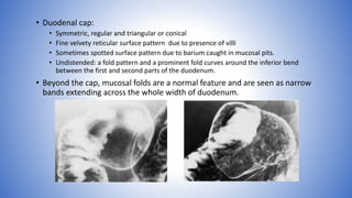 • Duodenal cap:
• Symmetric, regular and triangular or conical
• Fine velvety reticular surface pattern due to presence of villi
• Sometimes spotted surface pattern due to barium caught in mucosal pits.
• Undistended: a fold pattern and a prominent fold curves around the inferior bend
between the first and second parts of the duodenum.
• Beyond the cap, mucosal folds are a normal feature and are seen as narrow
bands extending across the whole width of duodenum.
 