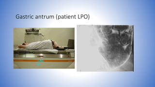 Gastric antrum (patient LPO)
 