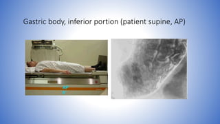 Gastric body, inferior portion (patient supine, AP)
 