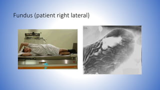 Fundus (patient right lateral)
 