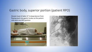 Gastric body, superior portion (patient RPO)
Elevate head of table 15° to keep barium from
flowing back into gastric fundus as the patient
rolls back into RPO position
 