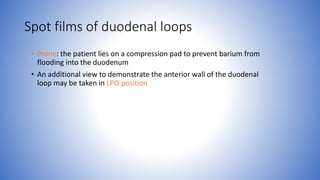 Spot films of duodenal loops
• Prone: the patient lies on a compression pad to prevent barium from
flooding into the duodenum
• An additional view to demonstrate the anterior wall of the duodenal
loop may be taken in LPO position
 