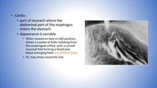 • Cardia :
• part of stomach where the
abdominal part of the esophagus
enters the stomach.
• Appearance is variable
• When viewed en face in LAO position,
shows a rosette of folds radiating from
the esophageal orifice, with a curved
mucosal fold forming a hood over
these emerging folds – BURNAUS SIGN
• Or, may show crescentic line
 