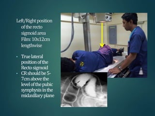 Left/Rightposition
oftherecto
sigmoidarea
Film:10x12cm
lengthwise
• Truelateral
positionofthe
Rectosigmoid
• CRshouldbe5-
7cmabovethe
levelofthepubic
symphysisinthe
midaxillaryplane
 