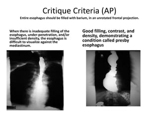 Critique Criteria (AP)
Entire esophagus should be filled with barium, in an unrotated frontal projection.
When there is inadequate filling of the
esophagus, under-penetration, and/or
insufficient density, the esophagus is
difficult to visualize against the
mediastinum.
Good filling, contrast, and
density, demonstrating a
condition called presby
esophagus
 