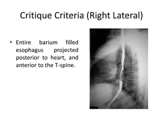 Critique Criteria (Right Lateral)
• Entire barium filled
esophagus projected
posterior to heart, and
anterior to the T-spine.
 