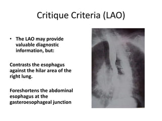 Critique Criteria (LAO)
• The LAO may provide
valuable diagnostic
information, but:
Contrasts the esophagus
against the hilar area of the
right lung.
Foreshortens the abdominal
esophagus at the
gasteroesophageal junction
 