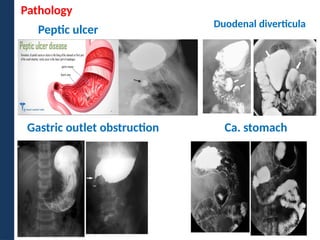 Hampton Line Barium Studies of upper GI Tract by joginder.pptx