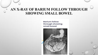 BARIUM STUDIES PRESENTATION RADIOGRAPHYpptx | PPTX