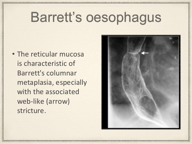 Esophageal Stricture Barium Swallow Gastroesophageal Reflux Disease