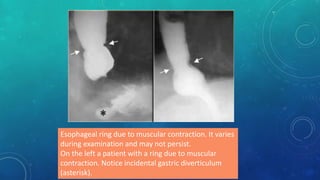 Esophageal ring due to muscular contraction. It varies
during examination and may not persist.
On the left a patient with a ring due to muscular
contraction. Notice incidental gastric diverticulum
(asterisk).
 