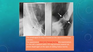 The esophageal B-ring is located at the squamocolumnar
junction,
The appearance does not change during the examination.
On the left a patient with a 'B' ring (arrows) several cm
above diaphragm at the apex of sliding hiatus hernia.
 
