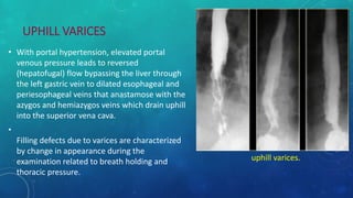 UPHILL VARICES
• With portal hypertension, elevated portal
venous pressure leads to reversed
(hepatofugal) flow bypassing the liver through
the left gastric vein to dilated esophageal and
periesophageal veins that anastamose with the
azygos and hemiazygos veins which drain uphill
into the superior vena cava.
•
Filling defects due to varices are characterized
by change in appearance during the
examination related to breath holding and
thoracic pressure.
uphill varices.
 