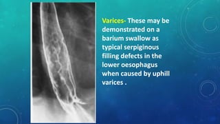 Varices- These may be
demonstrated on a
barium swallow as
typical serpiginous
filling defects in the
lower oesophagus
when caused by uphill
varices .
 