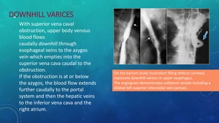 DOWNHILL VARICES
•
With superior vena caval
obstruction, upper body venous
blood flows
caudally downhill through
esophageal veins to the azygos
vein which empties into the
superior vena cava caudal to the
obstruction.
If the obstruction is at or below
the azygos, the blood flow extends
further caudally to the portal
system and then the hepatic veins
to the inferior vena cava and the
right atrium.
On the barium study inconstant filling defects (arrows)
represent downhill varices in upper esophagus.
The angiogram demonstrates collateral vessels including a
dilated left superior intercostal vein (arrow).
 