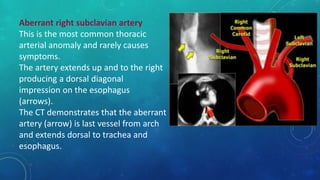 Aberrant right subclavian artery
This is the most common thoracic
arterial anomaly and rarely causes
symptoms.
The artery extends up and to the right
producing a dorsal diagonal
impression on the esophagus
(arrows).
The CT demonstrates that the aberrant
artery (arrow) is last vessel from arch
and extends dorsal to trachea and
esophagus.
 