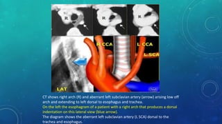 CT shows right arch (R) and aberrant left subclavian artery (arrow) arising low off
arch and extending to left dorsal to esophagus and trachea.
On the left the esophagram of a patient with a right arch that produces a dorsal
indentation on this lateral view (blue arrow).
The diagram shows the aberrant left subclavian artery (L SCA) dorsal to the
trachea and esophagus.
 