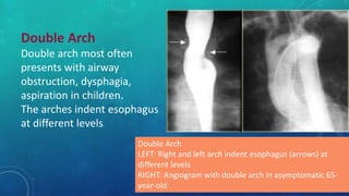 Double Arch
Double arch most often
presents with airway
obstruction, dysphagia,
aspiration in children.
The arches indent esophagus
at different levels.
Double Arch
LEFT: Right and left arch indent esophagus (arrows) at
different levels
RIGHT: Angiogram with double arch in asymptomatic 65-
year-old
 