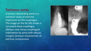 Tortuous aorta
A tortous descending aorta is a
common cause of extrinsic
impression on the esophagus.
The image on the far left shows a
narrowed distal esophagus.
Oblique view shows esophageal
indentation by aorta with obtuse
margins (arrows) characteristic of
extrinsic compression.
 