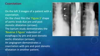 Coarctation
On the left 3 images of a patient with a
coarctation.
On the chest film the 'Figure 3' shape
of aortic knob due pre and post
stenotic dilatation (arrows).
The barium study demonstrates the
'Reverse 3 figure' indention of
esophagus by pre and post stenotic
aortic dilatation (arrows).
An angiogram demonstrates a
coarctation with pre and post stenotic
dilatation in another patient.
 