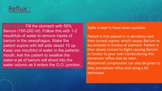 Table is kept in head down position.
Patient is first placed in Lt decubitus and
then turned supine; which causes Barium to
accumulate in fundus of stomach. Patient is
then slowly turned to Right causing Barium
in fundus to pour over Cardia;during this
maneuver reflux may be seen.
Abdominal compression can also be given to
help precipitate reflux and using a DC
technique.
Siphon test. Fill the stomach with 50%
Barium (150-200 ml). Follow this with 1-2
mouthfuls of water to remove traces of
barium in the oesophagus. Make the
patient supine with left side raised 15 up.
Keep one mouthful of water in the patients
mouth. Ask the patient to swallow the
water-a jet of barium will shoot into the
water column as it enters the G.O. junction.
Reflux :
 