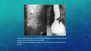 Air-contrast esophagram shows thick esophageal mucosal folds (arrows)
and an ulcer (arrowhead) due to GERD.
Single contrast esophagram shows stricture (arrow) and sliding hiatus
hernia
 