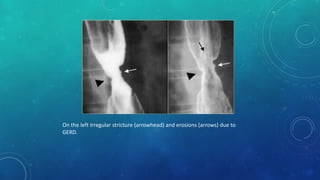 On the left Irregular stricture (arrowhead) and erosions (arrows) due to
GERD.
 