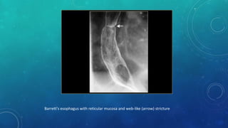 Barrett's esophagus with reticular mucosa and web-like (arrow) stricture
 
