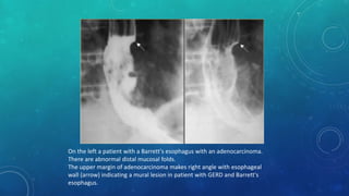 On the left a patient with a Barrett's esophagus with an adenocarcinoma.
There are abnormal distal mucosal folds.
The upper margin of adenocarcinoma makes right angle with esophageal
wall (arrow) indicating a mural lesion in patient with GERD and Barrett's
esophagus.
 