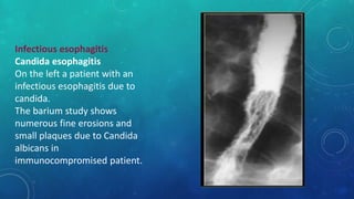 Infectious esophagitis
Candida esophagitis
On the left a patient with an
infectious esophagitis due to
candida.
The barium study shows
numerous fine erosions and
small plaques due to Candida
albicans in
immunocompromised patient.
 