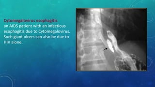 Cytomegalovirus esophagitis
an AIDS patient with an infectious
esophagitis due to Cytomegalovirus.
Such giant ulcers can also be due to
HIV alone.
 