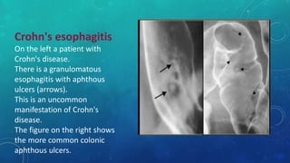 Crohn's esophagitis
On the left a patient with
Crohn's disease.
There is a granulomatous
esophagitis with aphthous
ulcers (arrows).
This is an uncommon
manifestation of Crohn's
disease.
The figure on the right shows
the more common colonic
aphthous ulcers.
 