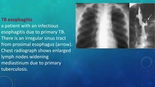 TB esophagitis
a patient with an infectious
esophagitis due to primary TB.
There is an irregular sinus tract
from proximal esophagus (arrow).
Chest radiograph shows enlarged
lymph nodes widening
mediastinum due to primary
tuberculosis.
 