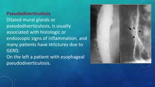 Pseudodiverticulosis
Dilated mural glands or
pseudodiverticulosis, is usually
associated with histologic or
endoscopic signs of inflammation, and
many patients have strictures due to
GERD.
On the left a patient with esophageal
pseudodiverticulosis.
 