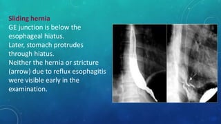Sliding hernia
GE junction is below the
esophageal hiatus.
Later, stomach protrudes
through hiatus.
Neither the hernia or stricture
(arrow) due to reflux esophagitis
were visible early in the
examination.
 