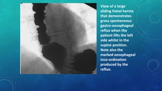 View of a large
sliding hiatal hernia
that demonstrates
gross spontaneous
gastro-oesophageal
reflux when the
patient lifts the left
side whilst in the
supine position.
Note also the
marked oesophageal
inco-ordination
produced by the
reflux.
 