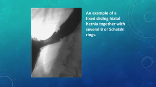 An example of a
fixed sliding hiatal
hernia together with
several B or Schatski
rings.
 