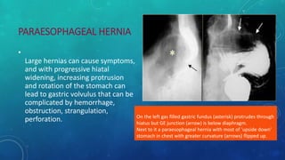 PARAESOPHAGEAL HERNIA
•
Large hernias can cause symptoms,
and with progressive hiatal
widening, increasing protrusion
and rotation of the stomach can
lead to gastric volvulus that can be
complicated by hemorrhage,
obstruction, strangulation,
perforation. On the left gas filled gastric fundus (asterisk) protrudes through
hiatus but GE junction (arrow) is below diaphragm.
Next to it a paraesophageal hernia with most of 'upside down'
stomach in chest with greater curvature (arrows) flipped up.
 