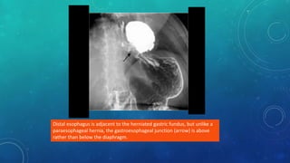 Distal esophagus is adjacent to the herniated gastric fundus, but unlike a
paraesophageal hernia, the gastroesophageal junction (arrow) is above
rather than below the diaphragm.
 
