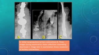 A. Initial nonpropulsive tertiary contractions B. Three
images during examination show collections resembling
diverticula C. Image later in examination shows resolution
of tertiary contractions
 