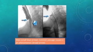Web (small blue arrow). Contrast passage causes a
jet phenomenon (broad arrow)
 