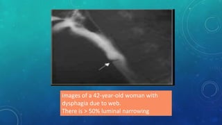 images of a 42-year-old woman with
dysphagia due to web.
There is > 50% luminal narrowing
 